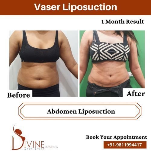 Abdomen-Liposuction-Before-After-April-2022.png-nggid03524-ngg0dyn-500x500x100-00f0w010c010r110f110r010t010