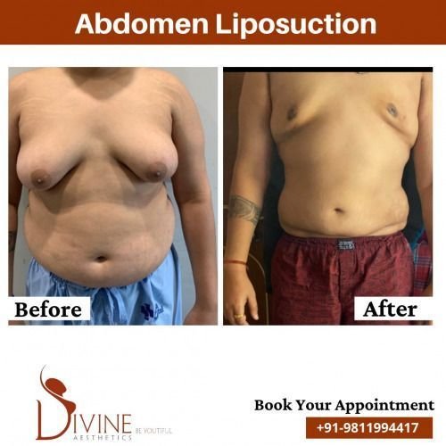 Abdomen-Liposuction-Before-After.jpeg-nggid03487-ngg0dyn-500x500x100-00f0w010c010r110f110r010t010