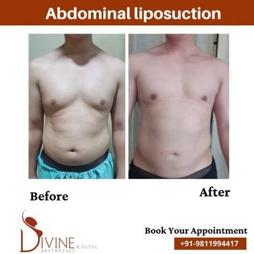 Abdominal-Liposuction-before-after-1-March-2022.jpeg-nggid03507-ngg0dyn-500x500x100-00f0w010c010r110f110r010t010