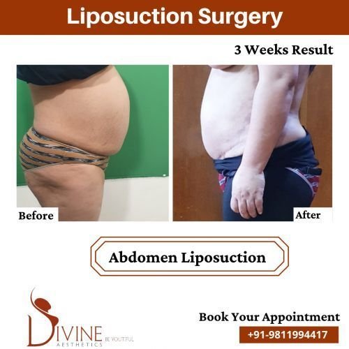 Abodmen-Liposuction-from-Side.png-nggid03523-ngg0dyn-500x500x100-00f0w010c010r110f110r010t010