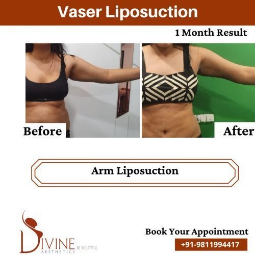 Arm-Liposuction-Before-After-April-2022.png-nggid03521-ngg0dyn-500x500x100-00f0w010c010r110f110r010t010