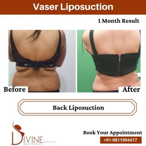 Back-Liposuction-Before-After-April-2022.png-nggid03525-ngg0dyn-500x500x100-00f0w010c010r110f110r010t010