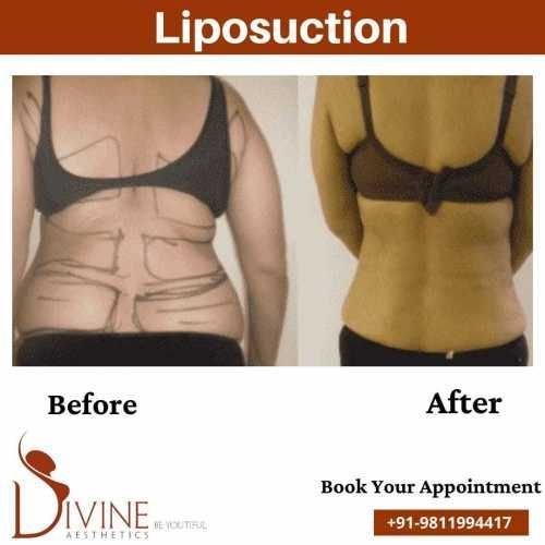 Back-Liposuction-Surgery-before-after.jpeg-nggid0264-ngg0dyn-500x500x100-00f0w010c010r110f110r010t010