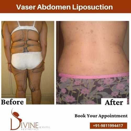 Back-Vaser-Abdomen-liposuction-before-after-surgery-done-by-doctor-Amit-Gupta.jpeg-nggid03319-ngg0dyn-500x500x100-00f0w010c010r110f110r010t010