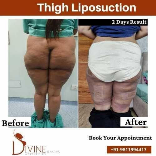 Back-Vaser-thigh-liposuction-before-after-surgery-done-by-doctor-Amit-Gupta.jpeg-nggid03324-ngg0dyn-500x500x100-00f0w010c010r110f110r010t010