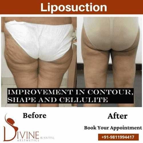 Back-thigh-Liposuction-Surgery-before-after-picture.jpeg-nggid0265-ngg0dyn-500x500x100-00f0w010c010r110f110r010t010