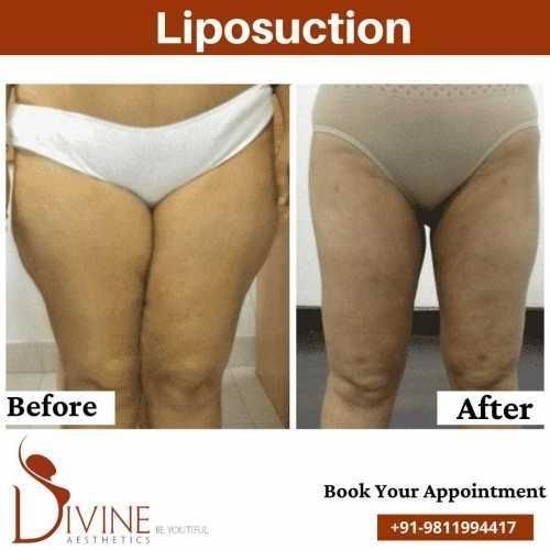 Female-thigh-Liposuction-Before-After.jpeg-nggid0266-ngg0dyn-500x500x100-00f0w010c010r110f110r010t010