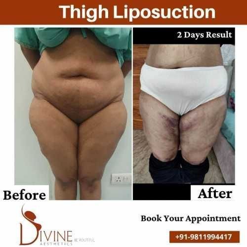 Front-Vaser-thigh-liposuction-before-after-surgery-done-by-doctor-Amit-Gupta.jpeg-nggid03323-ngg0dyn-500x500x100-00f0w010c010r110f110r010t010