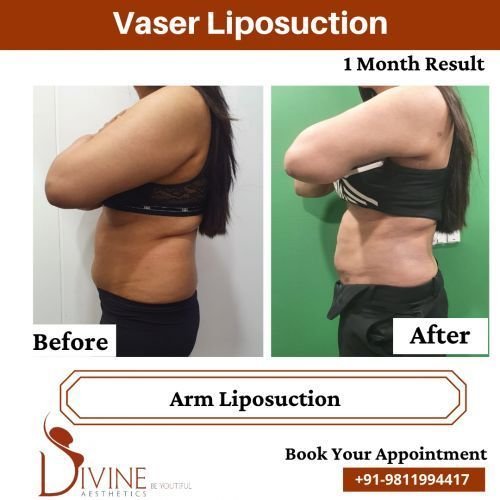 Side-Arm-Liposuction-Before-After-April-2022.png-nggid03526-ngg0dyn-500x500x100-00f0w010c010r110f110r010t010