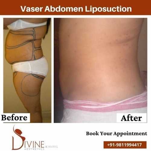 Side-Vaser-Abdomen-liposuction-before-after-surgery-done-by-doctor-Amit-Gupta.jpeg-nggid03318-ngg0dyn-500x500x100-00f0w010c010r110f110r010t010