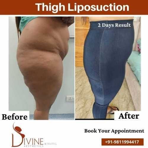 Side-Vaser-thigh-liposuction-before-after-surgery-done-by-doctor-Amit-Gupta.jpeg-nggid03322-ngg0dyn-500x500x100-00f0w010c010r110f110r010t010