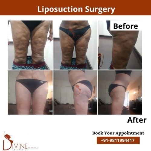 Thigh-Liposuction-Before-After-Results.png-nggid0267-ngg0dyn-500x500x100-00f0w010c010r110f110r010t010