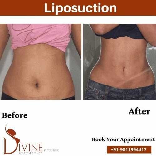 Tummy-Liposuction-Surgery-by-Divine-Cosmetic-Surgery.jpeg-nggid0268-ngg0dyn-500x500x100-00f0w010c010r110f110r010t010