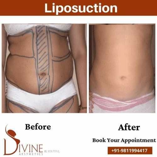 Tummy-Liposuction-Surgery-by-Dr.-Amit-Gupta.jpeg-nggid0269-ngg0dyn-500x500x100-00f0w010c010r110f110r010t010