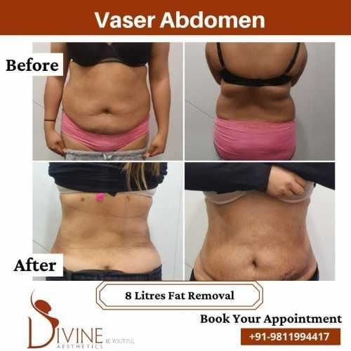Vaser-Abdomen-Before-After-1-Feb-22.jpeg-nggid03486-ngg0dyn-500x500x100-00f0w010c010r110f110r010t010