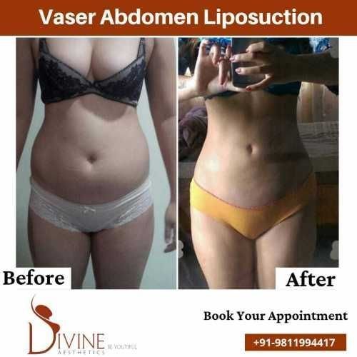 Vaser-Abdomen-liposuction-before-after-surgery-done-by-doctor-Amit-Gupta.jpeg-nggid03317-ngg0dyn-500x500x100-00f0w010c010r110f110r010t010