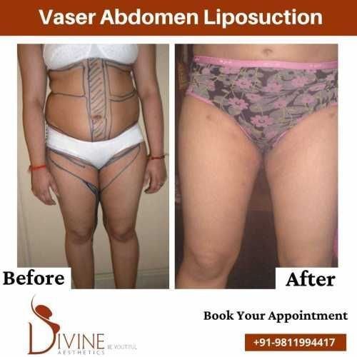 Vaser-Abdomen-liposuction-before-after-surgery-done-by-dr-Amit-Gupta.jpeg-nggid03321-ngg0dyn-500x500x100-00f0w010c010r110f110r010t010
