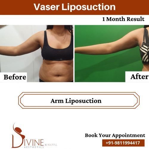 Vaser-Arm-Liposuction-Before-After-April-2022.png-nggid03522-ngg0dyn-500x500x100-00f0w010c010r110f110r010t010