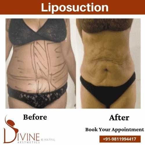 Vaser-Liposuction-Surgery-result.jpeg-nggid0262-ngg0dyn-500x500x100-00f0w010c010r110f110r010t010