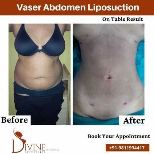 front-Vaser-Abdomen-liposuction-before-after-surgery-done-by-doctor-Amit-Gupta.jpeg-nggid03320-ngg0dyn-500x500x100-00f0w010c010r110f110r010t010