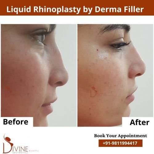 nose-rhinoplasty-2.png-nggid03102-ngg0dyn-500x500x100-00f0w010c010r110f110r010t010