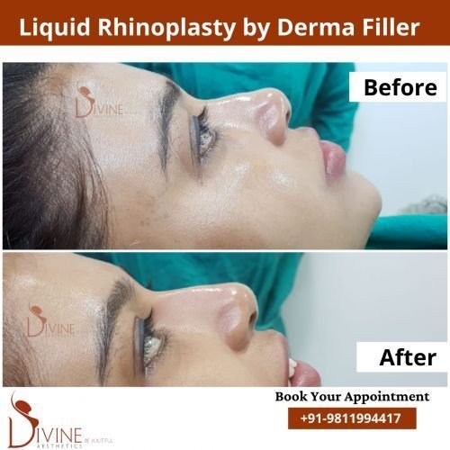 nose-rhinoplasty-3.png-nggid03103-ngg0dyn-500x500x100-00f0w010c010r110f110r010t010