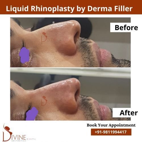 nose-rhinoplasty-4.png-nggid0299-ngg0dyn-500x500x100-00f0w010c010r110f110r010t010