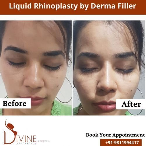 nose-rhinoplasty-5.png-nggid03100-ngg0dyn-500x500x100-00f0w010c010r110f110r010t010