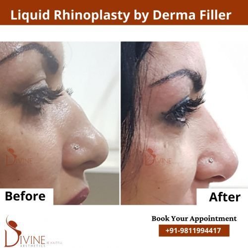 nose-rhinoplasty.png-nggid03101-ngg0dyn-500x500x100-00f0w010c010r110f110r010t010