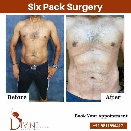 6-Pack-Abs-Surgery-before-After-Results.jpeg-nggid03348-ngg0dyn-500x500x100-00f0w010c010r110f110r010t010