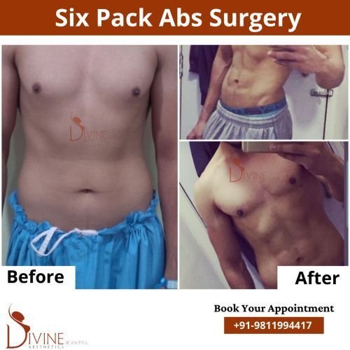 Six-Pack-Abs-Surgery-1.png-nggid0296-ngg0dyn-500x500x100-00f0w010c010r110f110r010t010
