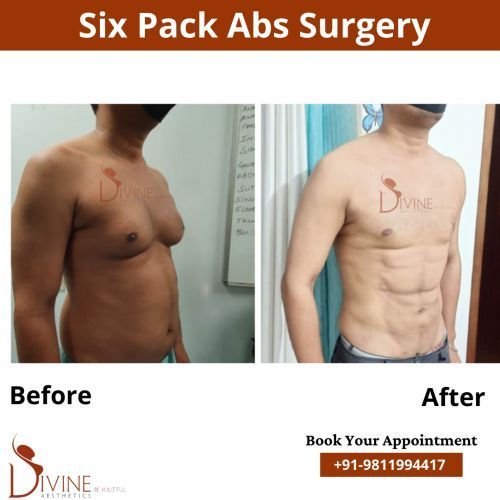 Six-Pack-Abs-Surgery-5.png-nggid0297-ngg0dyn-500x500x100-00f0w010c010r110f110r010t010