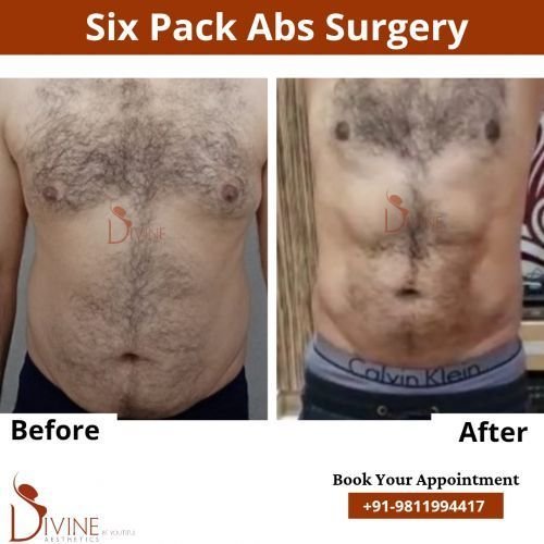 Six-Pack-Abs-Surgery-6.png-nggid0298-ngg0dyn-500x500x100-00f0w010c010r110f110r010t010