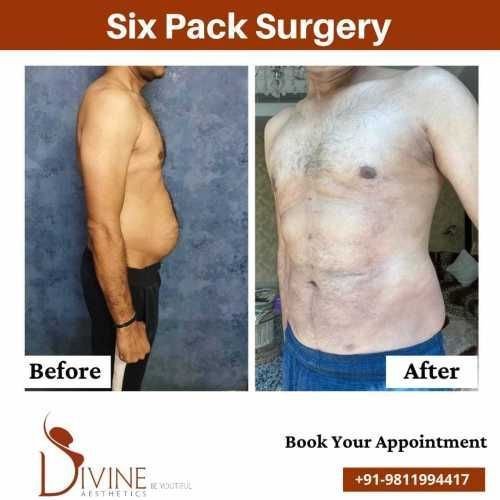 Six-Pack-Abs-Surgery-before-After-Results.jpeg-nggid03349-ngg0dyn-500x500x100-00f0w010c010r110f110r010t010