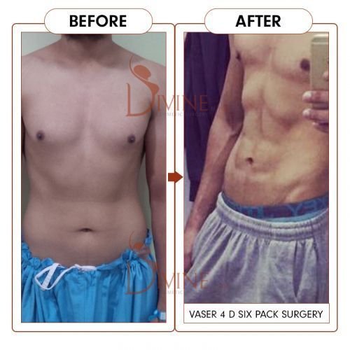 Six-Packs-Surgery-1.jpg-nggid0294-ngg0dyn-500x500x100-00f0w010c010r110f110r010t010