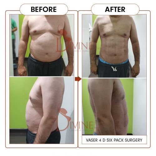 Six-Packs-Surgery-2.jpg-nggid0295-ngg0dyn-500x500x100-00f0w010c010r110f110r010t010