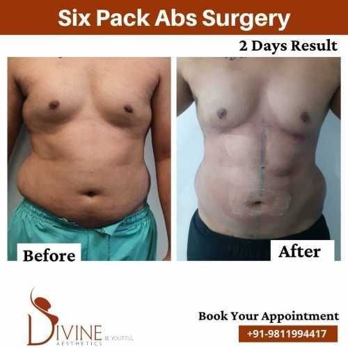Six-pack-abs-after-2-Days-result.jpeg-nggid03445-ngg0dyn-500x500x100-00f0w010c010r110f110r010t010