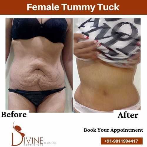 Female-Tummy-Tuck-Before-After.jpeg-nggid03316-ngg0dyn-500x500x100-00f0w010c010r110f110r010t010