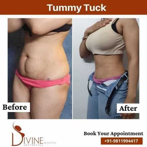 Side-Tummy-Tuck-Before-After-Results.jpeg-nggid03392-ngg0dyn-500x500x100-00f0w010c010r110f110r010t010
