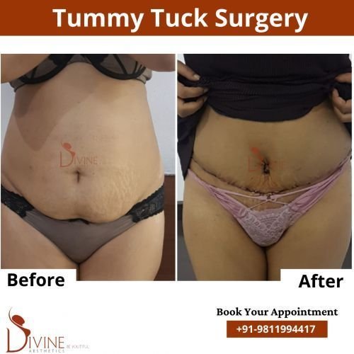 Tummy-Tuck-2.png-nggid0260-ngg0dyn-500x500x100-00f0w010c010r110f110r010t010