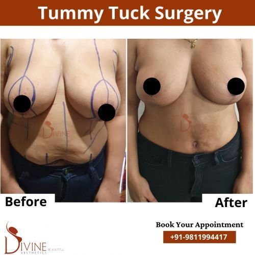 Tummy-Tuck-3.png-nggid0257-ngg0dyn-500x500x100-00f0w010c010r110f110r010t010