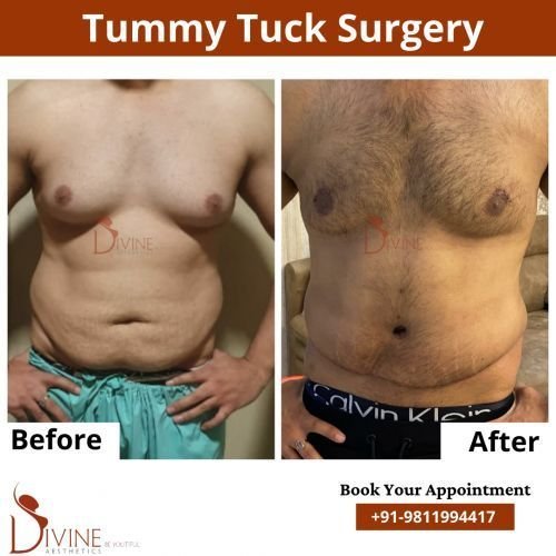 Tummy-Tuck-4.png-nggid0258-ngg0dyn-500x500x100-00f0w010c010r110f110r010t010
