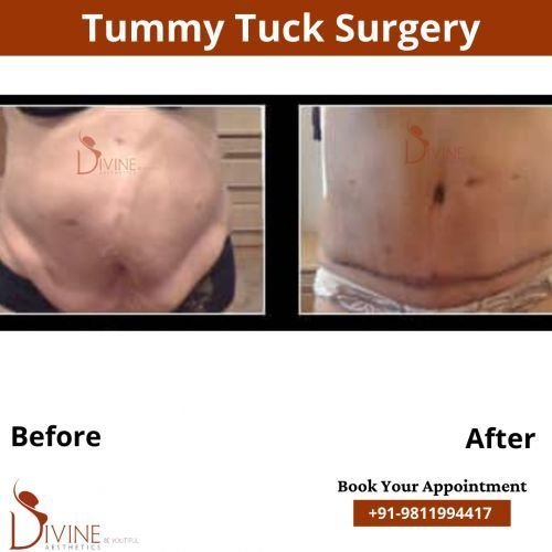 Tummy-Tuck-5.png-nggid0259-ngg0dyn-500x500x100-00f0w010c010r110f110r010t010