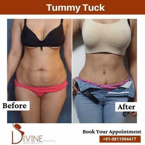 Tummy-Tuck-Before-After-Results.jpeg-nggid03391-ngg0dyn-500x500x100-00f0w010c010r110f110r010t010