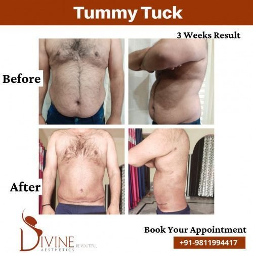 Tummy-Tuck-before-after-1-March-2022.jpeg-nggid03512-ngg0dyn-500x500x100-00f0w010c010r110f110r010t010