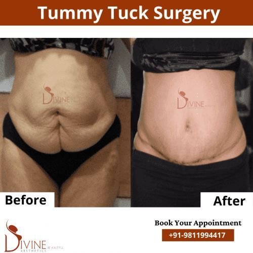 Tummy-Tuck-before-after.png-nggid0261-ngg0dyn-500x500x100-00f0w010c010r110f110r010t010