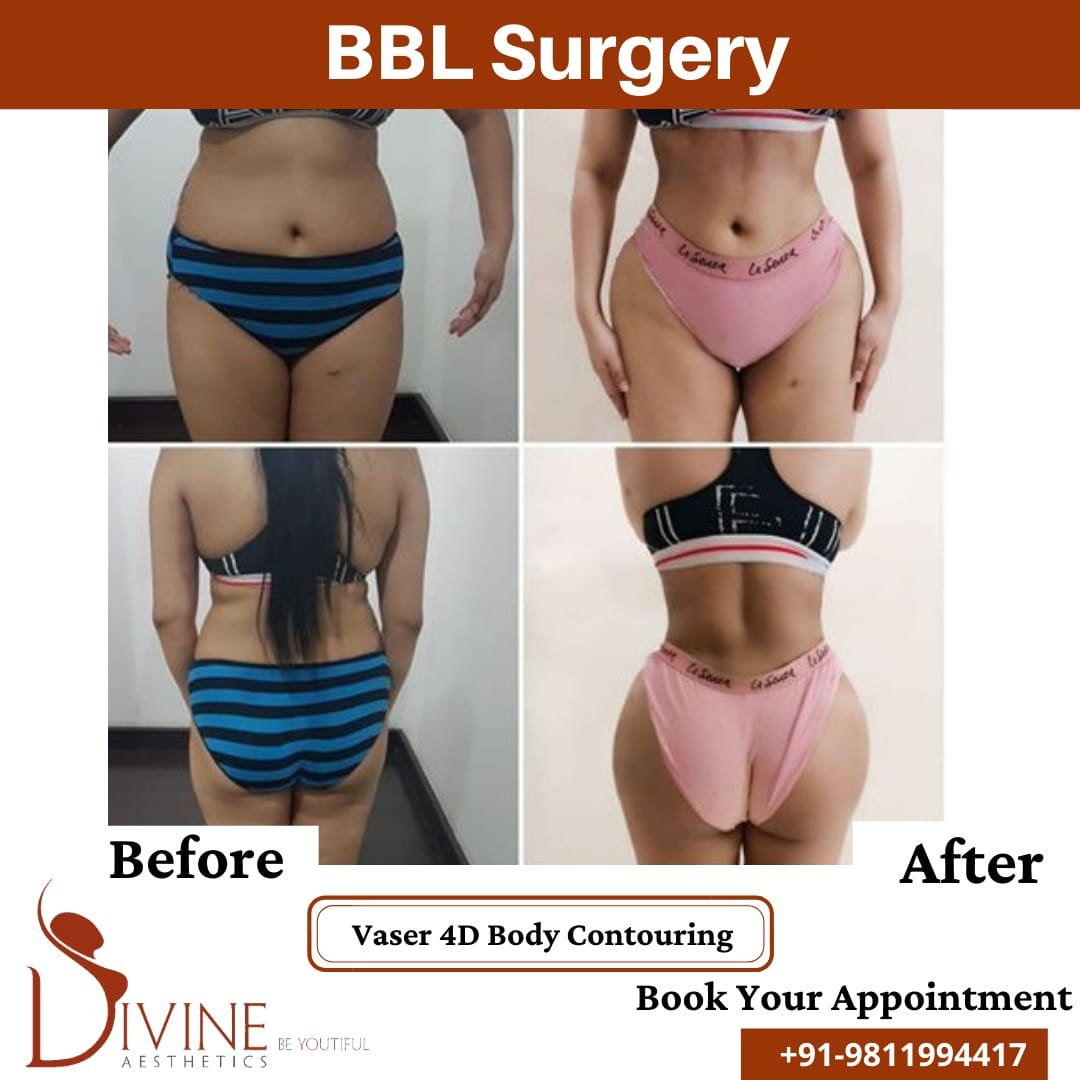 Brazilian Butt Lift before and after results