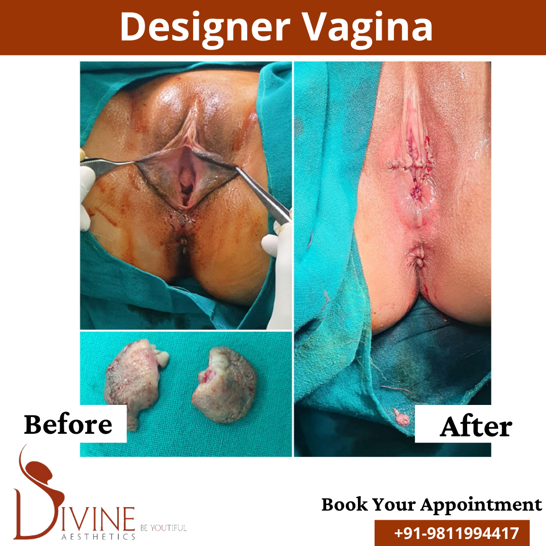 Designer Vagina Before and After Results, thr procedure done by Dr. AMit Gupta