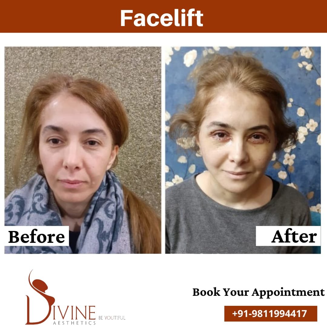 Facelift before After results Side