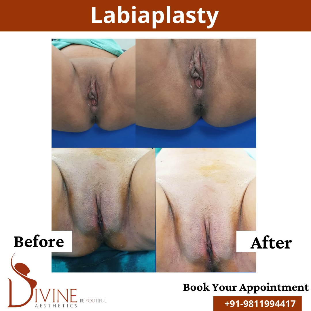 Labiaplasty Before and After Results, thr procedure done by Dr. AMit Gupta